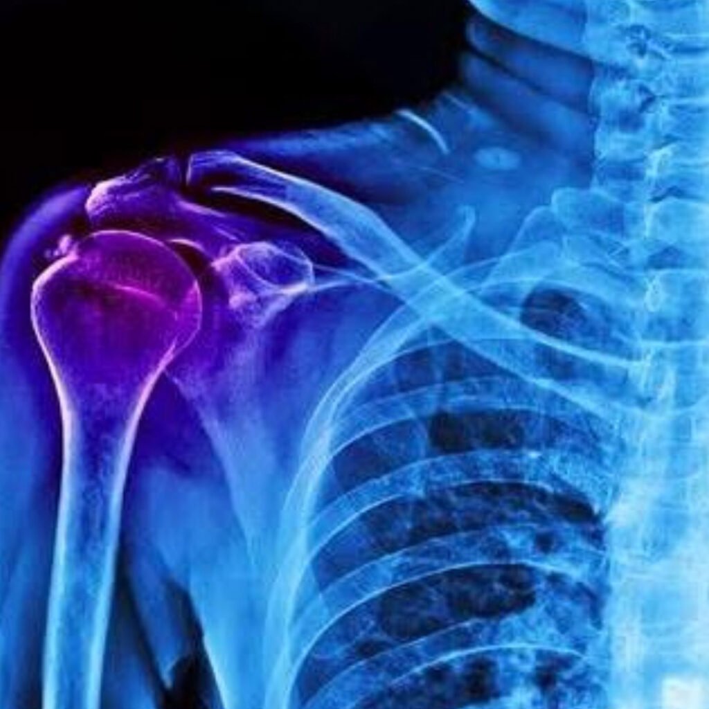 Physiotherapy treatment for Calcific Tendinitis aimed at relieving shoulder pain and improving joint mobility.