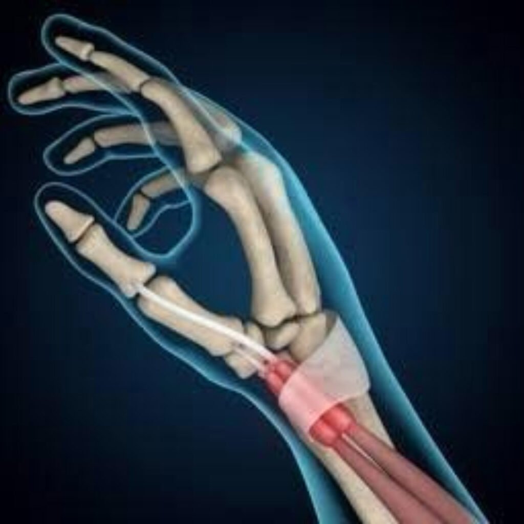Physiotherapy for Dequervain’s Tenosynovitis focusing on wrist pain reduction, tendon mobility, and hand strength restoration.