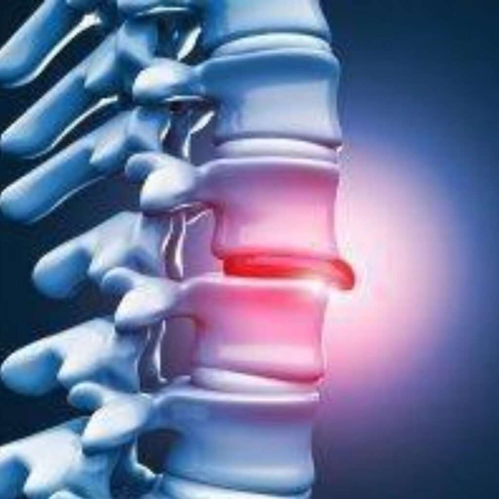 Physiotherapy for Disc Herniation focusing on spinal decompression, nerve pain relief, and posture correction.