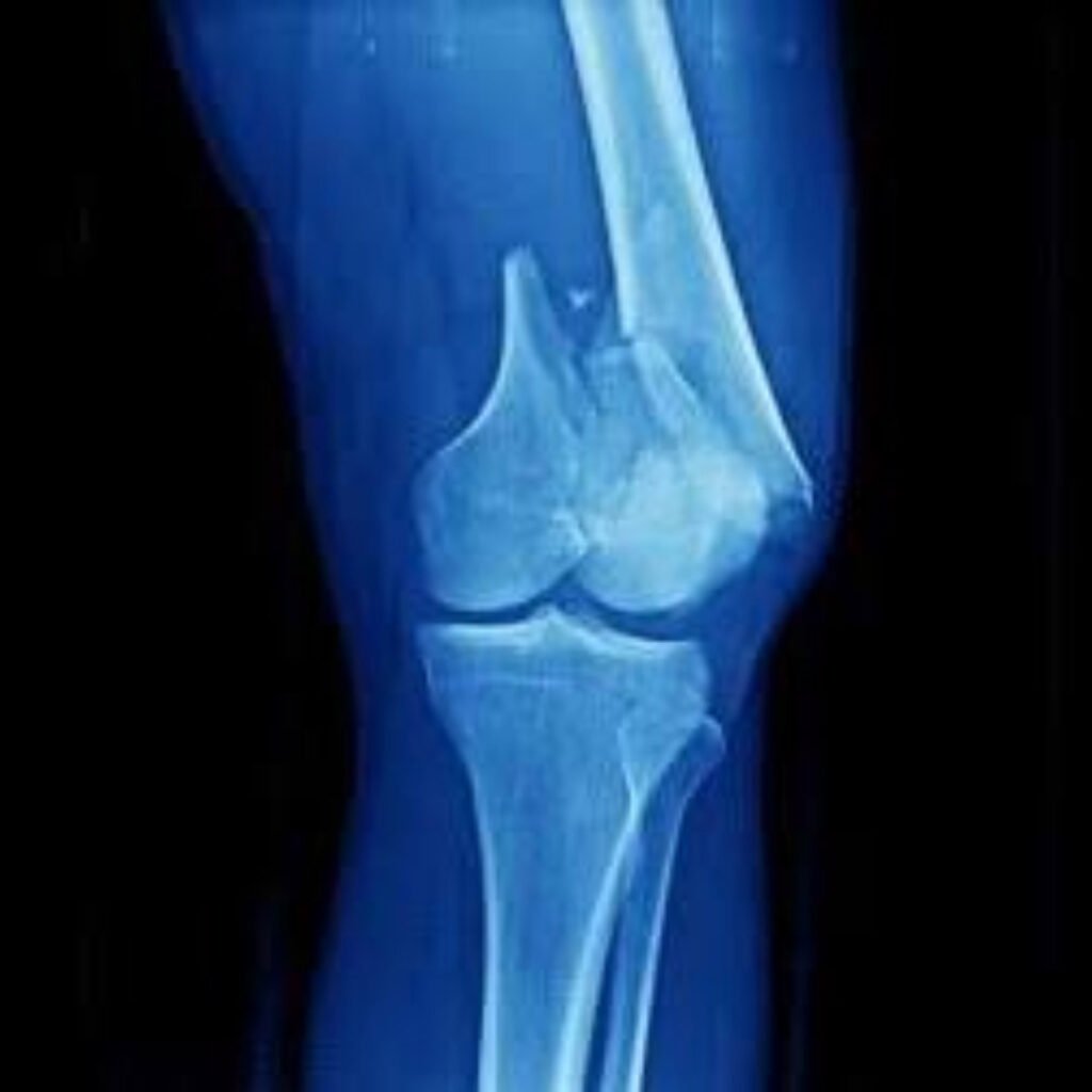 Physiotherapy rehabilitation for fractures focusing on joint mobility, muscle strength, and functional recovery.