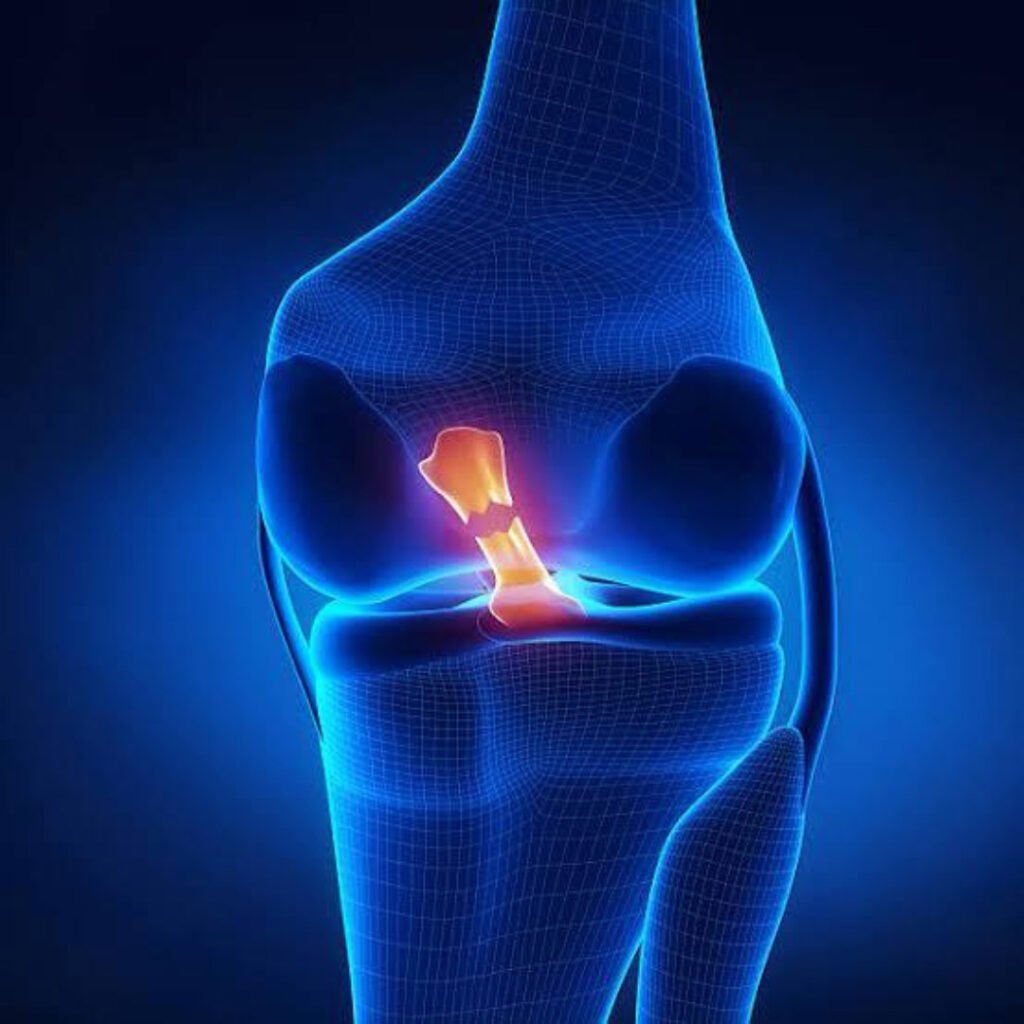 Physiotherapy rehabilitation for ligament tear focusing on pain reduction, joint stability, and muscle strengthening.