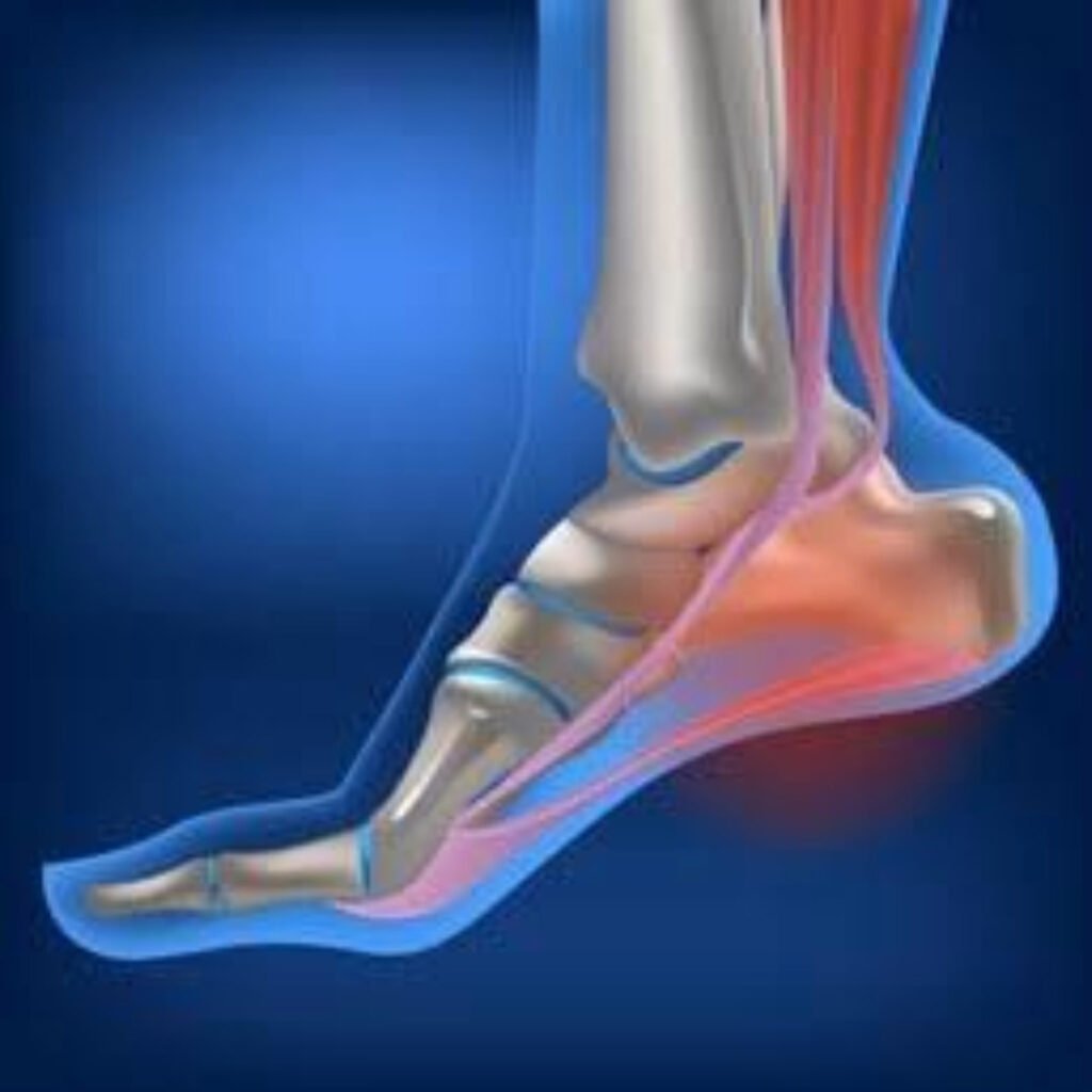 Physiotherapy treatment for Plantar Fasciitis focusing on heel pain relief, foot alignment, and mobility improvement.