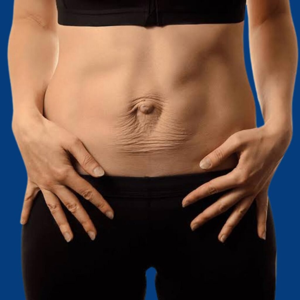 Physiotherapy for Diastasis Recti focusing on core strengthening, abdominal muscle recovery, and postnatal rehabilitation.