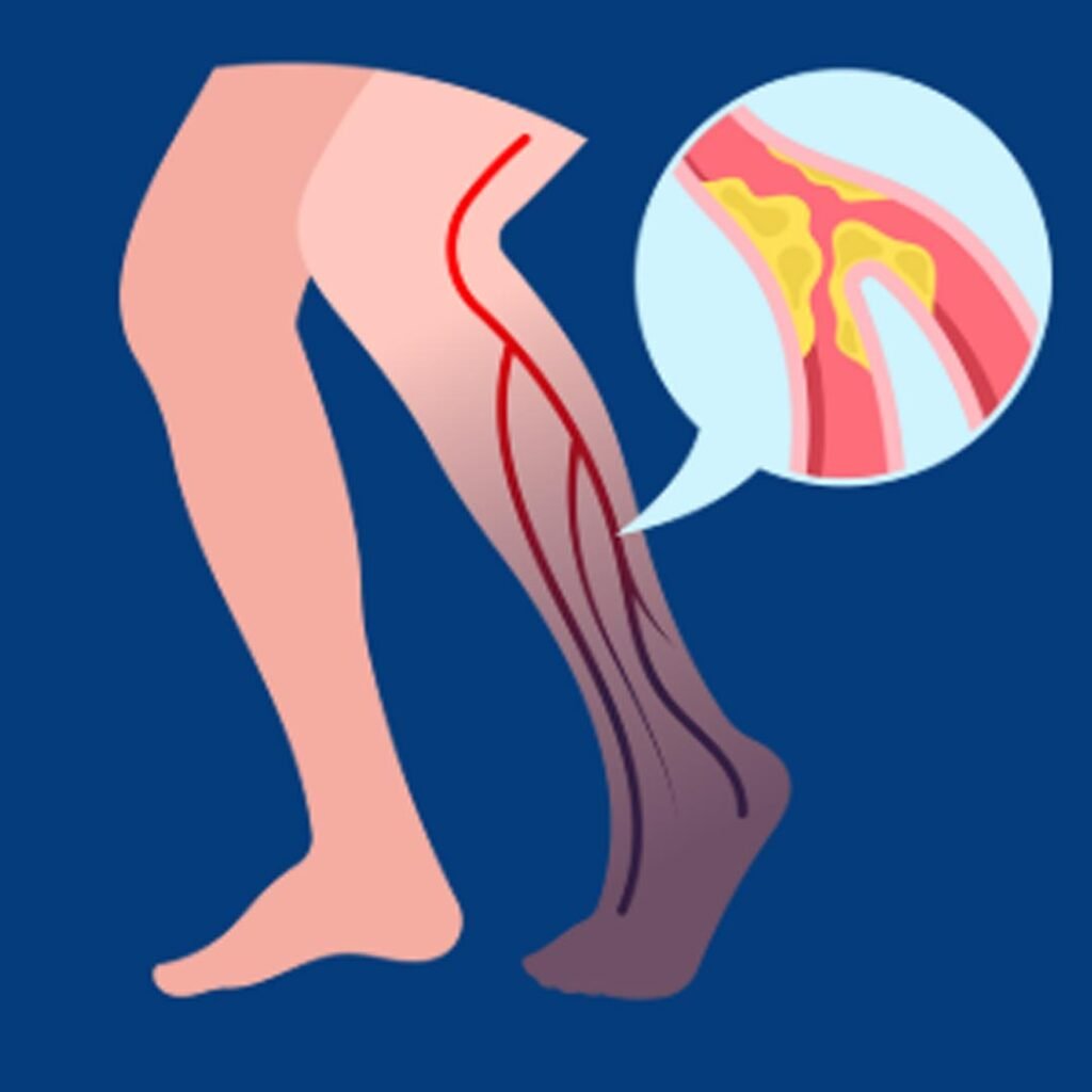 Physiotherapy for Foot Drop focusing on gait correction, muscle strengthening, and nerve rehabilitation.