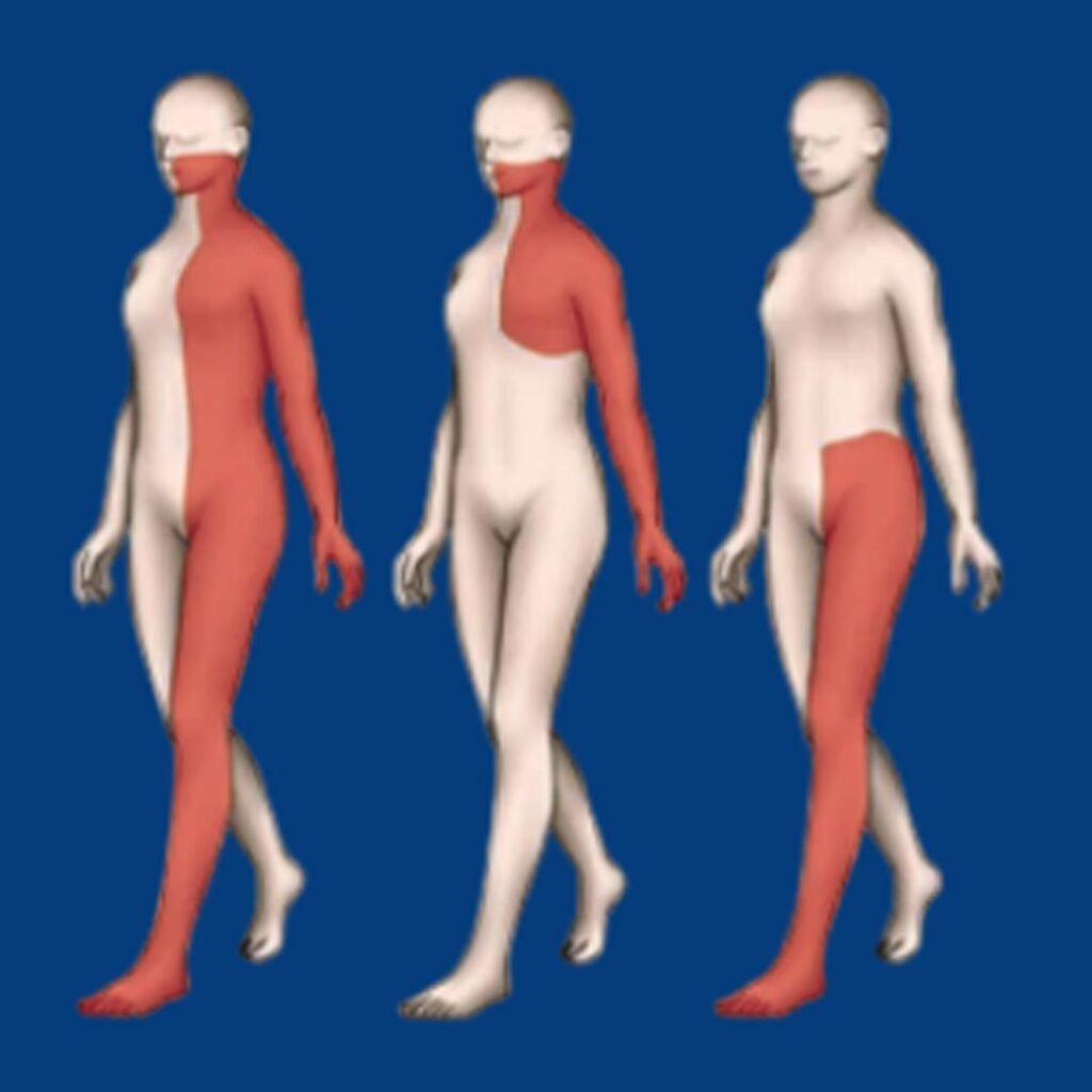 Physiotherapy for Hemiparesis focusing on muscle strengthening, balance training, and mobility recovery after stroke.