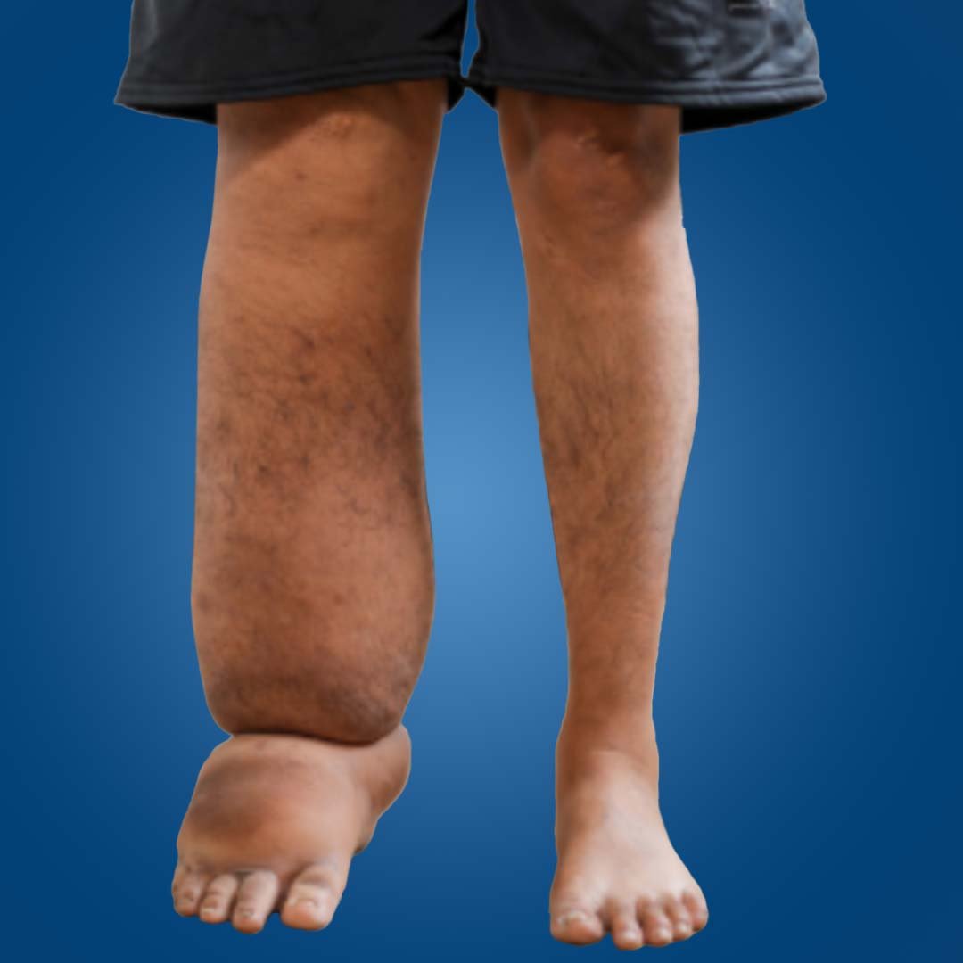 Physiotherapy for Lower Limb Lymphedema focusing on swelling reduction, lymphatic drainage, and leg mobility improvement.
