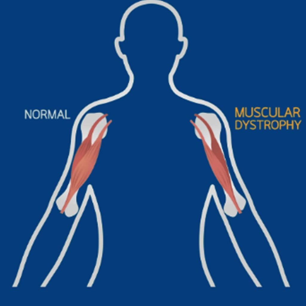 Physiotherapy for muscular dystrophy focusing on muscle strength, flexibility, and mobility improvement.