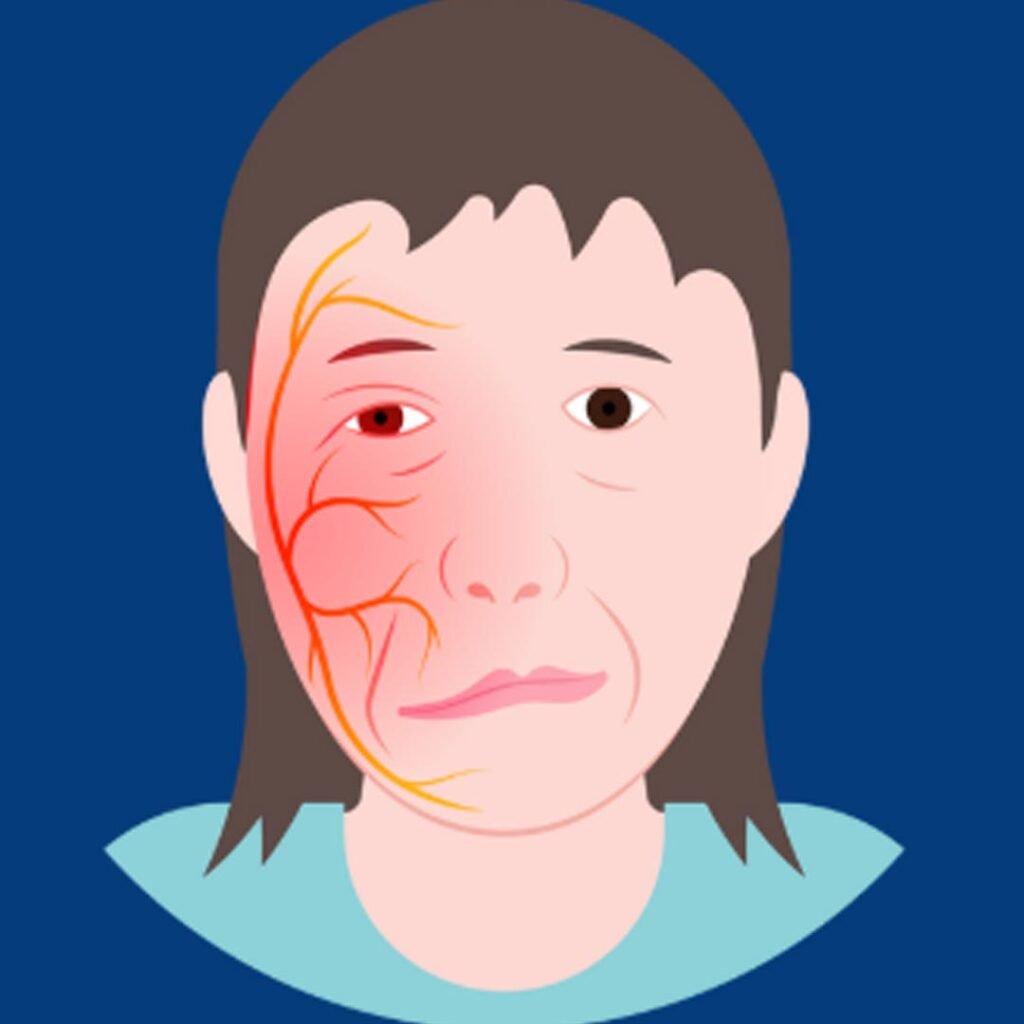 Physiotherapy for Myasthenia Gravis focusing on muscle strength improvement, fatigue management, and mobility support.