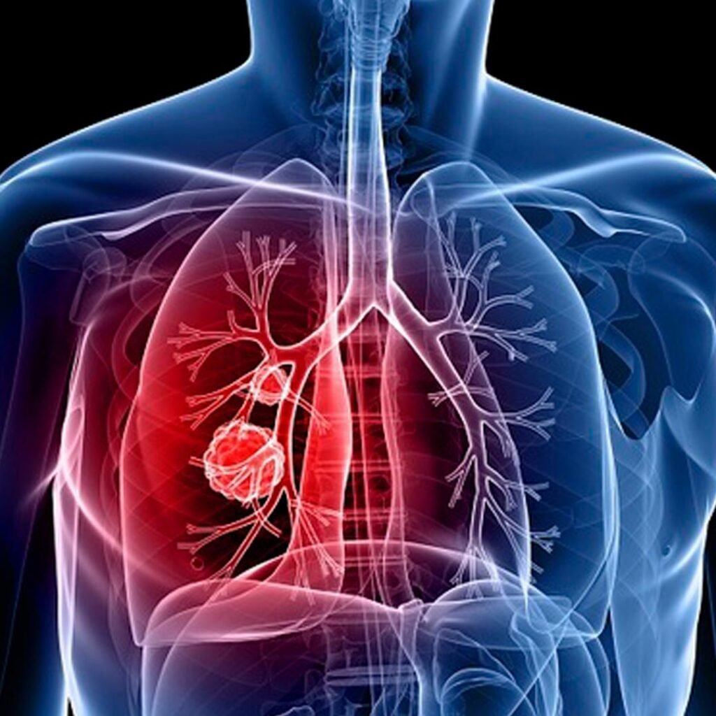 Pulmonary rehabilitation physiotherapy focusing on breathing exercises, lung function improvement, and respiratory health recovery.