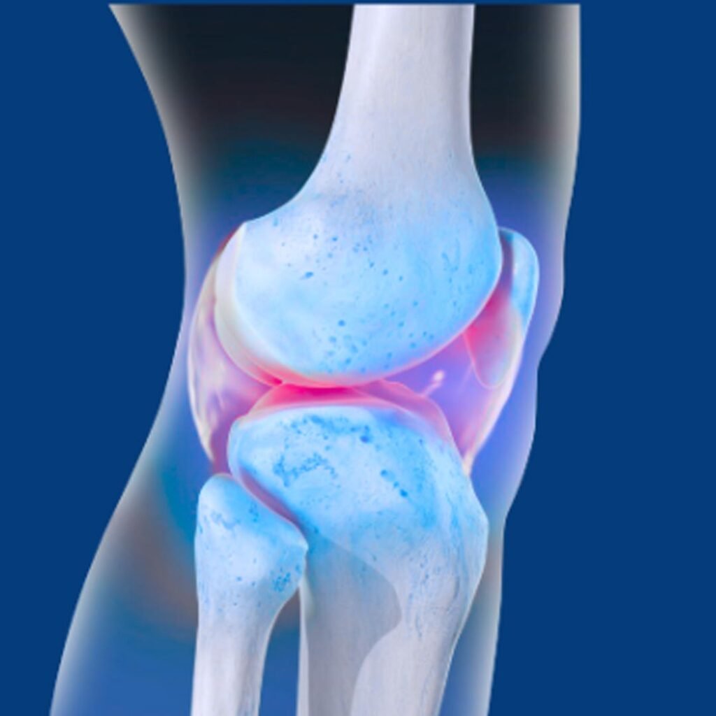 Physiotherapy for Septic Arthritis focusing on joint mobility, pain management, and post-infection rehabilitation.