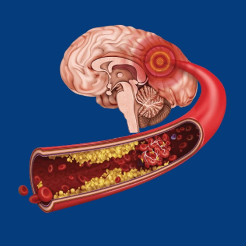 Physiotherapy rehabilitation for stroke recovery focusing on movement retraining, balance, and muscle coordination.