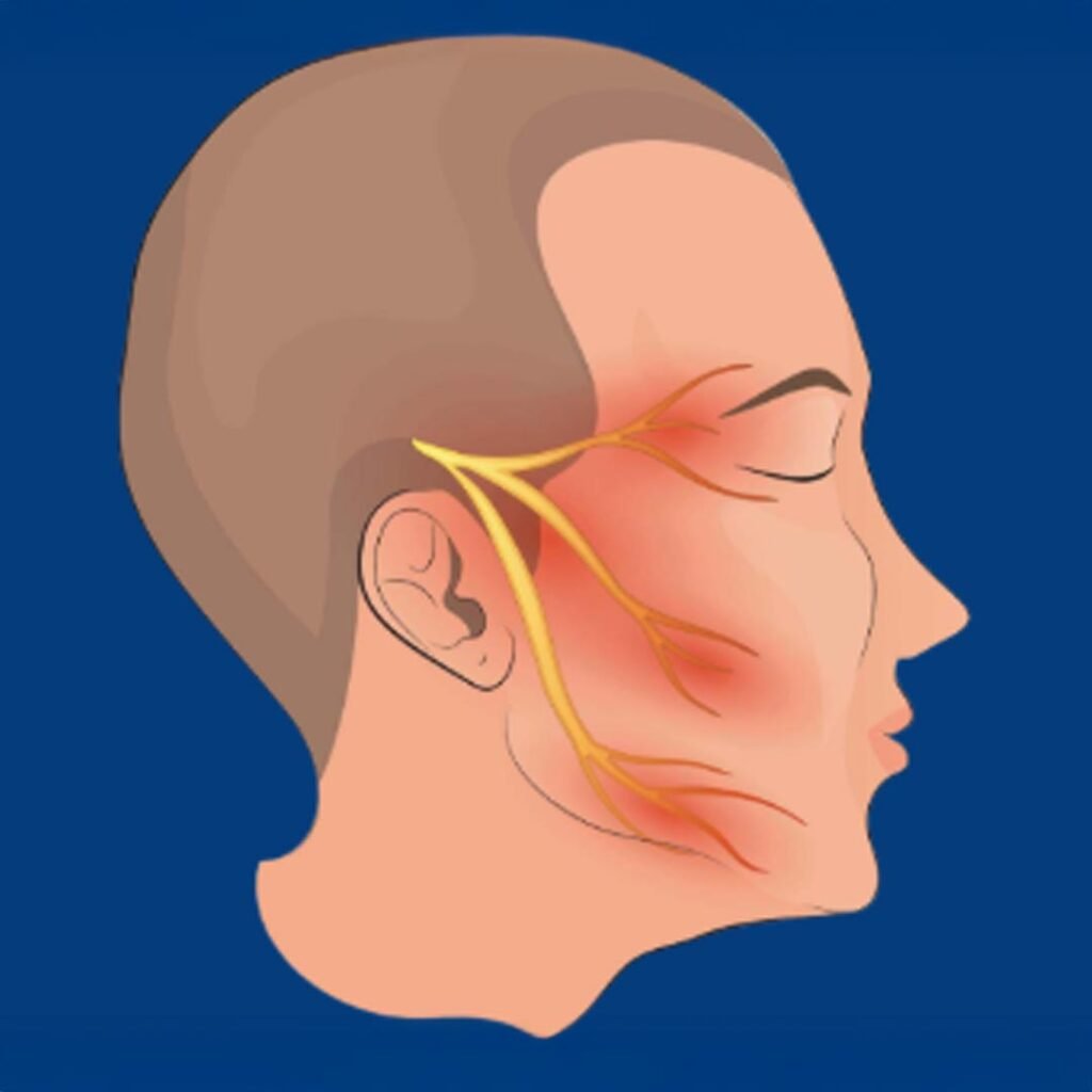 Physiotherapy and pain management for Trigeminal Neuralgia focusing on facial nerve relief and muscle relaxation.