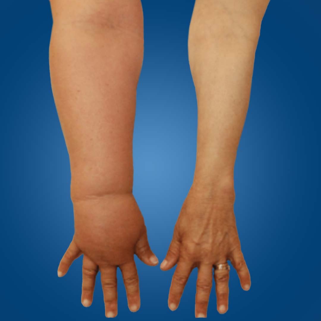 Physiotherapy for Upper Limb Lymphedema focusing on swelling reduction, lymphatic drainage, and arm mobility improvement.