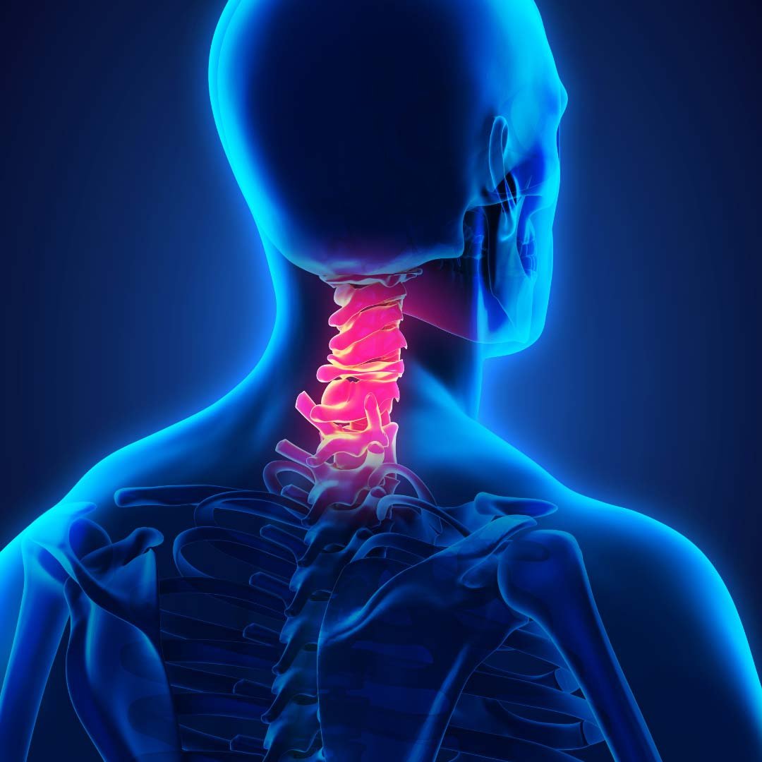 Physiotherapy for Cervical Radiculopathy focusing on neck pain relief, nerve decompression, and posture correction.