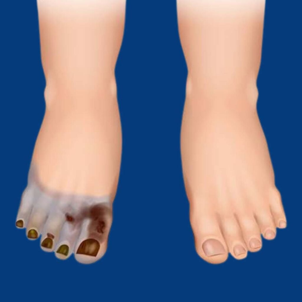 Physiotherapy and rehabilitation for Clostridial Myonecrosis or Gas Gangrene focusing on wound recovery, muscle strength, and mobility restoration.