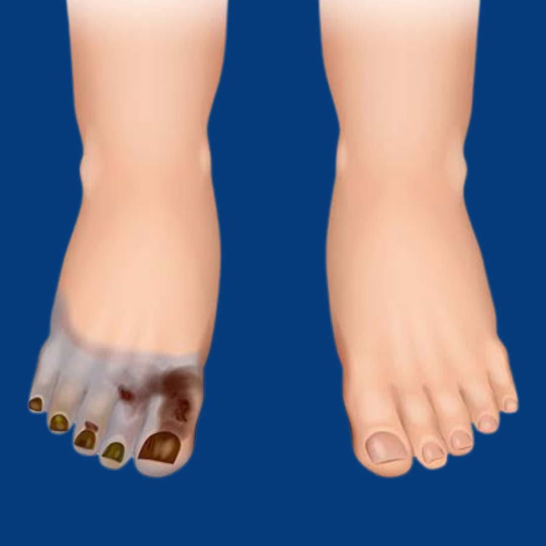 Physiotherapy and rehabilitation for Clostridial Myonecrosis or Gas Gangrene focusing on wound recovery, muscle strength, and mobility restoration.