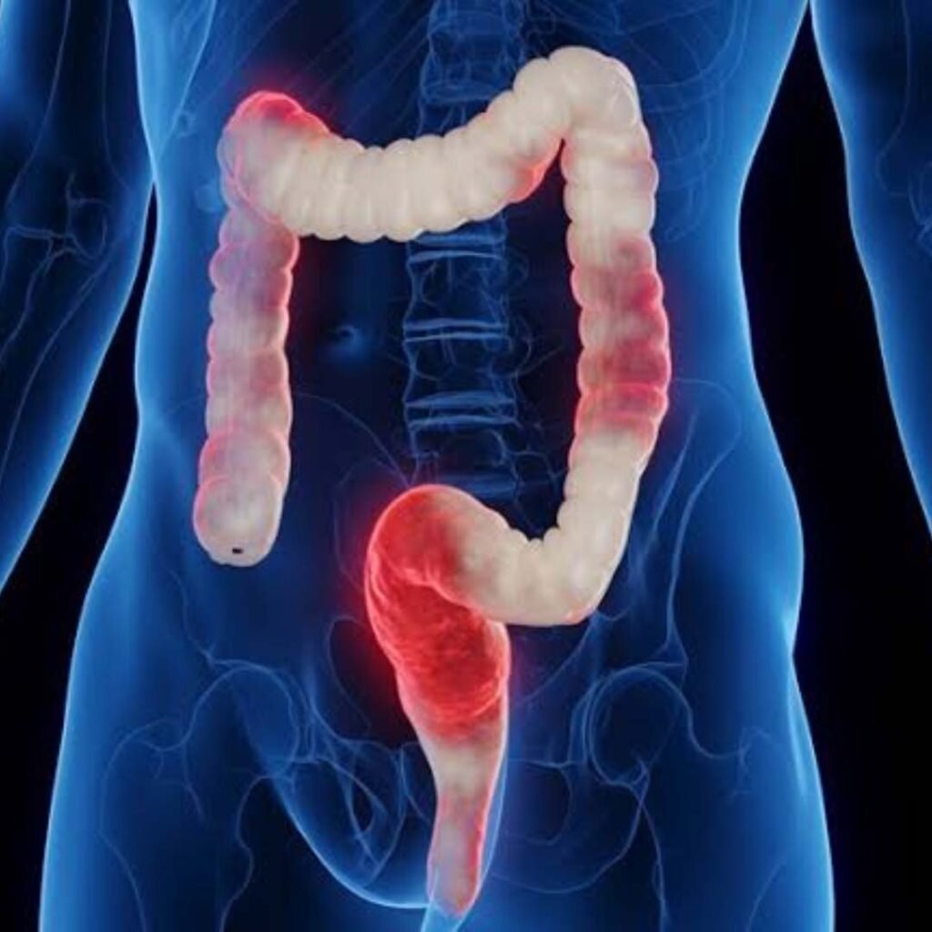 Physiotherapy and wellness management for Crohn’s Disease focusing on pain relief, mobility improvement, and fatigue reduction.