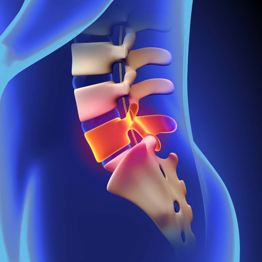 Physiotherapy for Lumbar Radiculopathy focusing on nerve pain relief, spinal alignment, and lower back mobility.