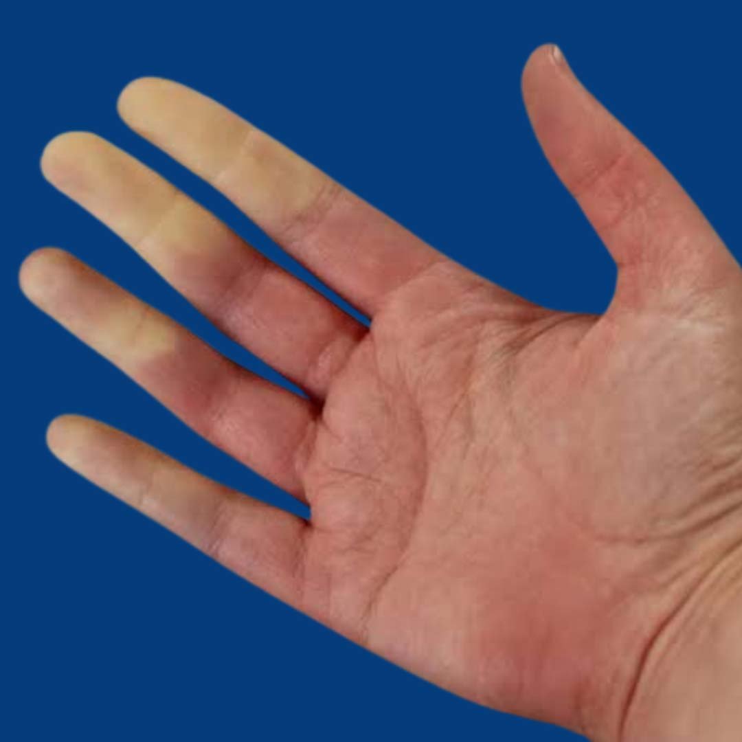 Physiotherapy for Raynaud’s Disease focusing on circulation improvement, pain relief, and hand mobility exercises.