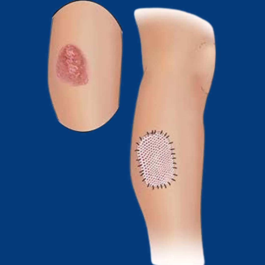 Physiotherapy rehabilitation after skin grafts and flaps focusing on scar mobility, tissue healing, and functional recovery.