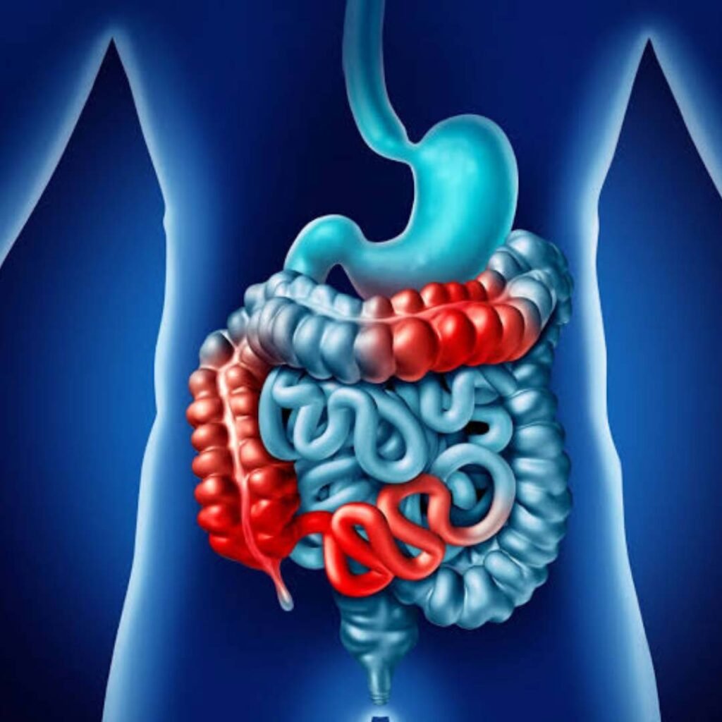 Physiotherapy and wellness care for Ulcerative Colitis focusing on pain management, stress reduction, and improved gut health.