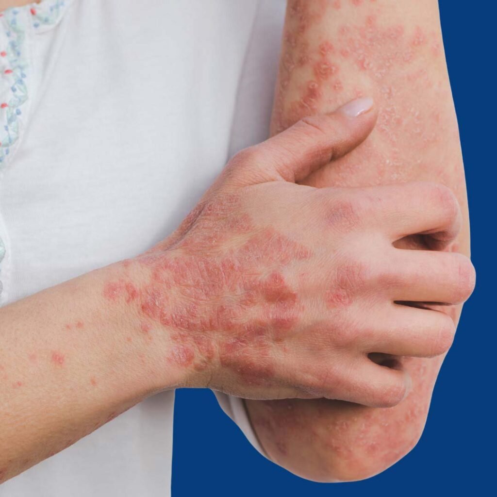 Physiotherapy for Lyme Disease focusing on joint pain relief, muscle strengthening, and mobility restoration.