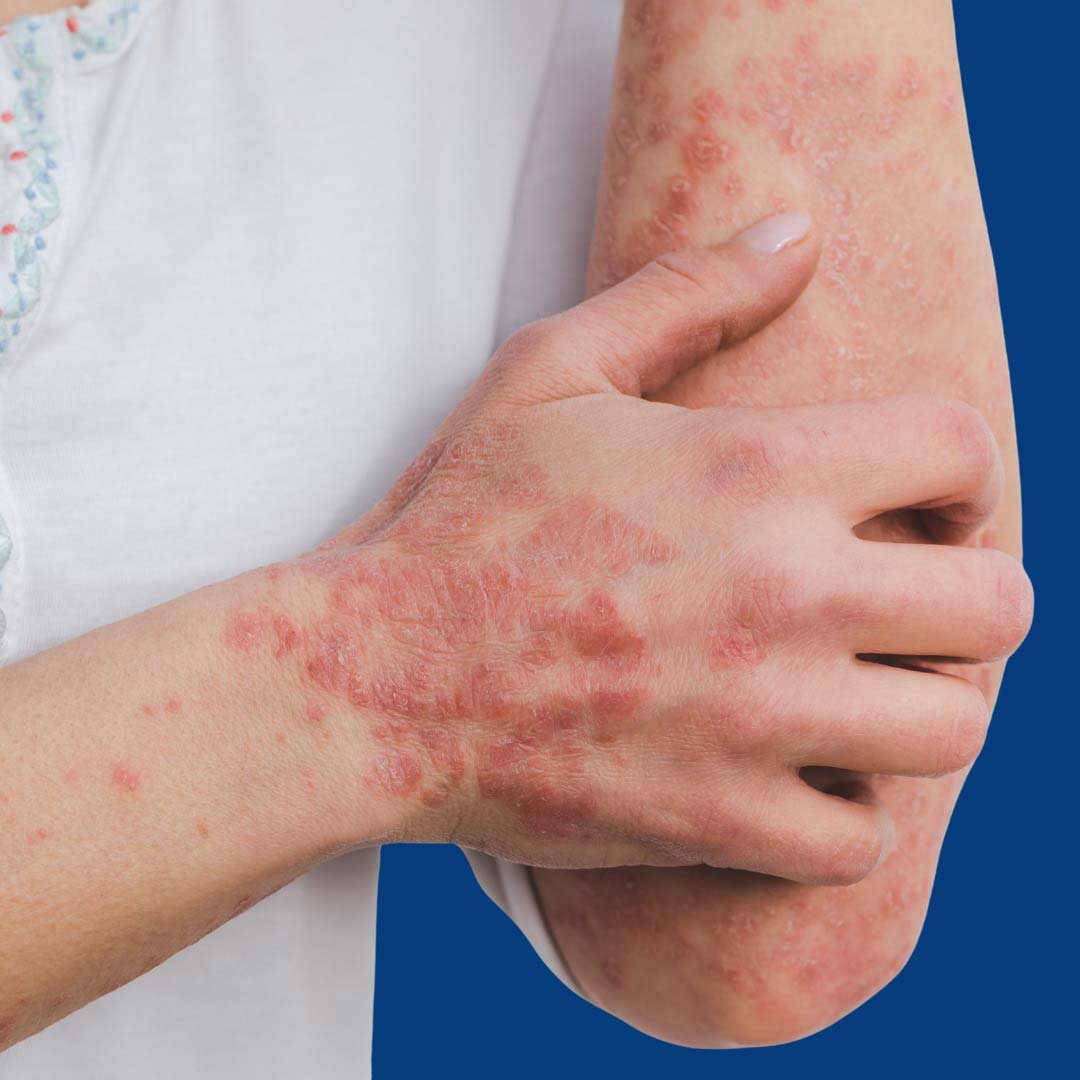 Physiotherapy for Lyme Disease focusing on joint pain relief, muscle strengthening, and mobility restoration.