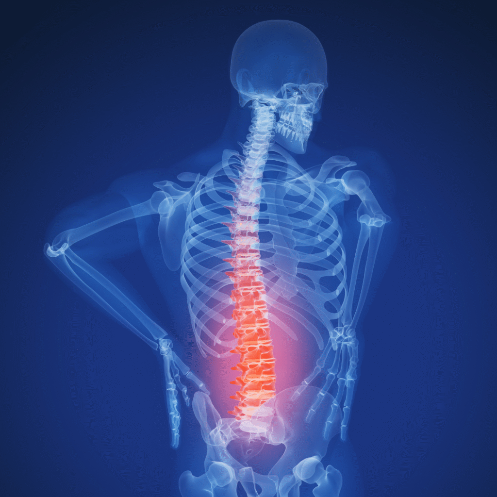 Physiotherapy session for Ankylosing Spondylitis focusing on spine mobility, posture correction, and pain management.