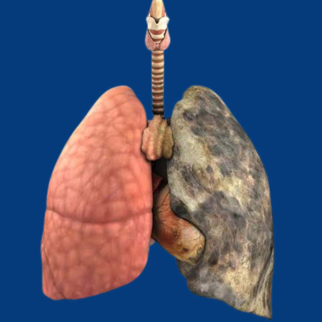 Physiotherapy and wellness program for smokers focusing on lung health, breathing exercises, and recovery support.