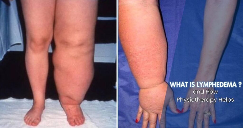 Lymphedema and How Physiotherapy Helps